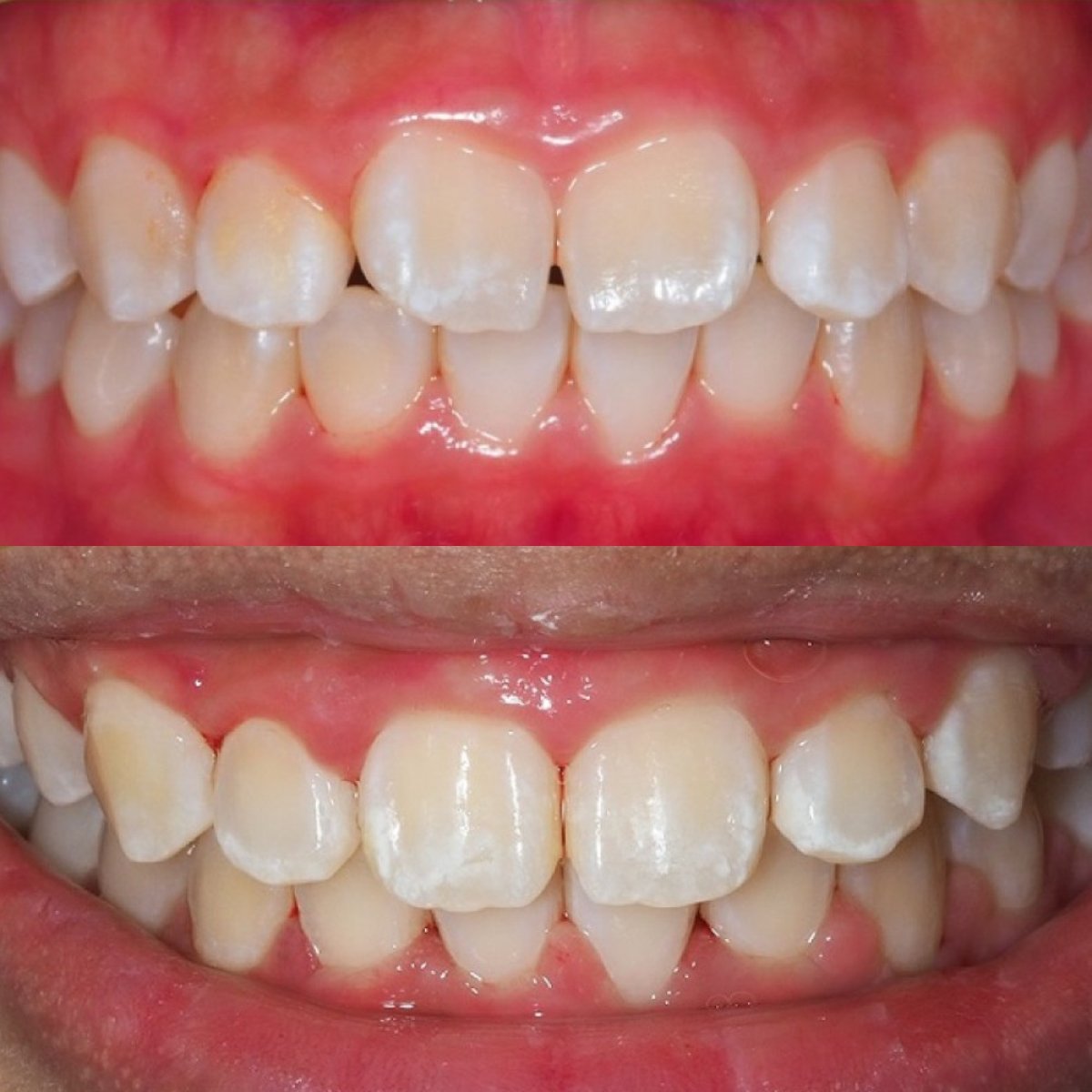 Before and after braces results at Stellar Dental – improved teeth alignment and smile