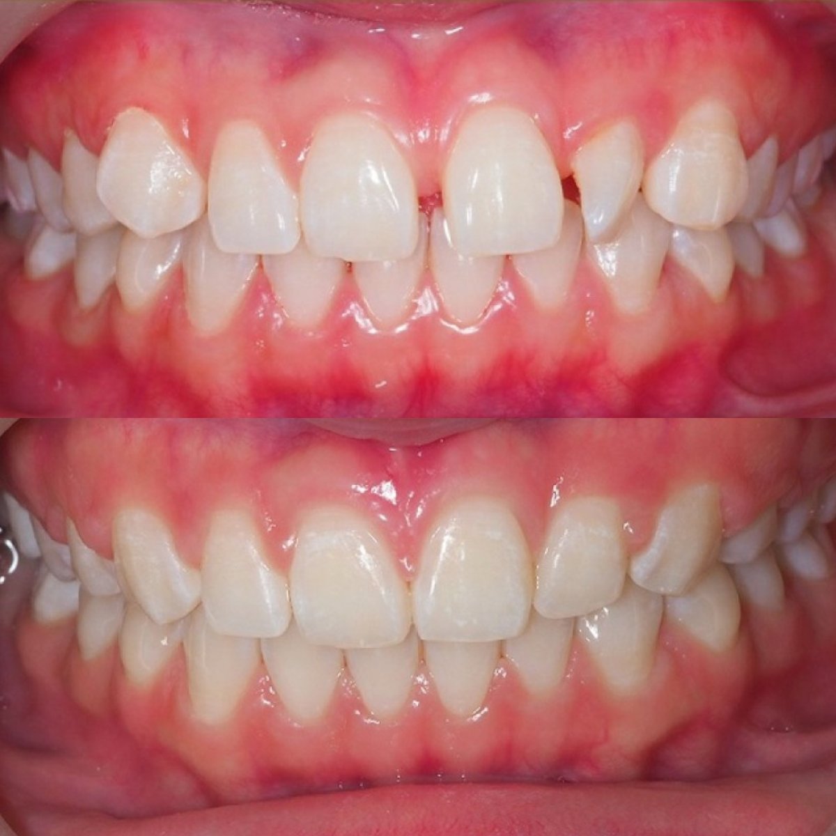 Before and after self-ligating braces results at Stellar Dental – improved teeth alignment