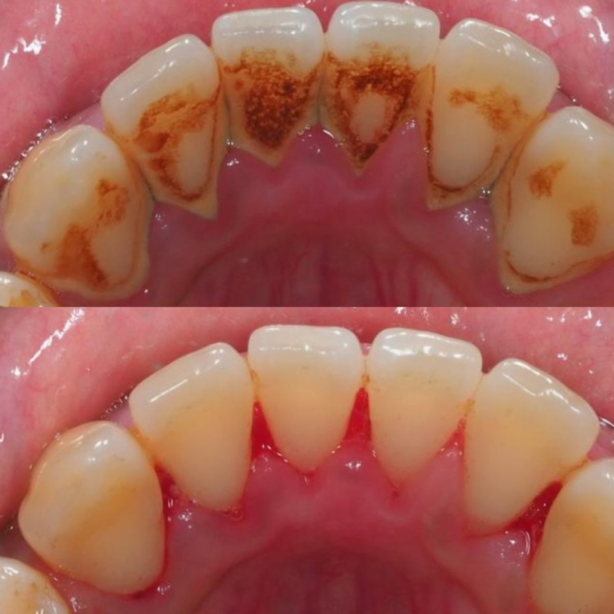 Результаты до и после чистки зубов (скейлинг) в Stellar Dental – удаление налета