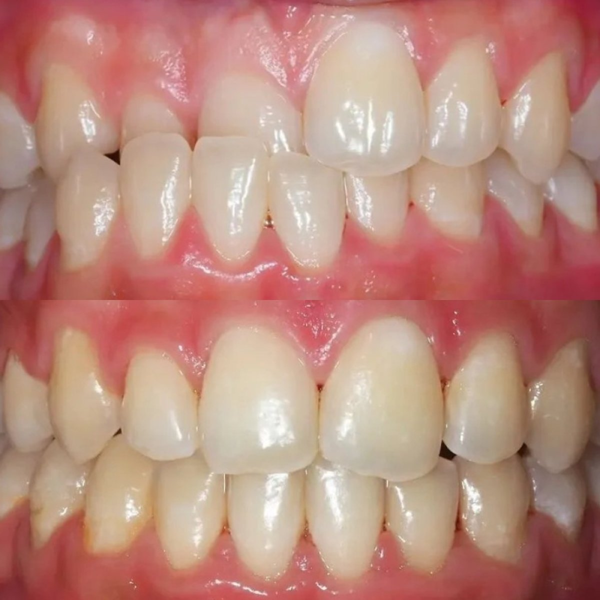Before and after self-ligating braces results at Stellar Dental – improved teeth alignment