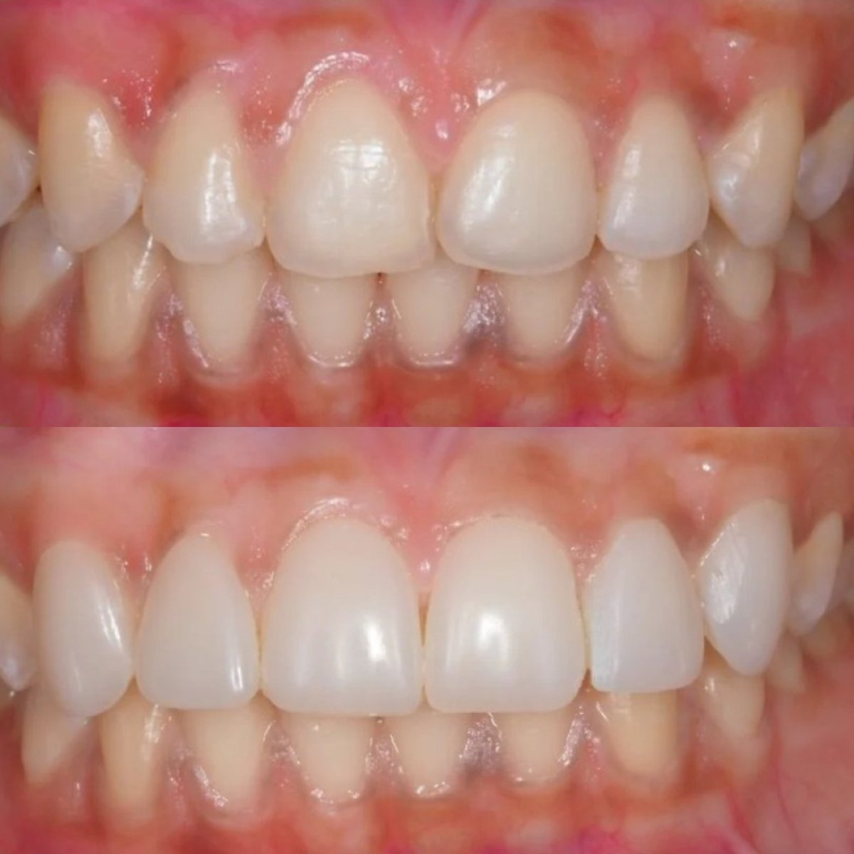 Before and after veneers at Stellar Dental – improved tooth color and alignment result