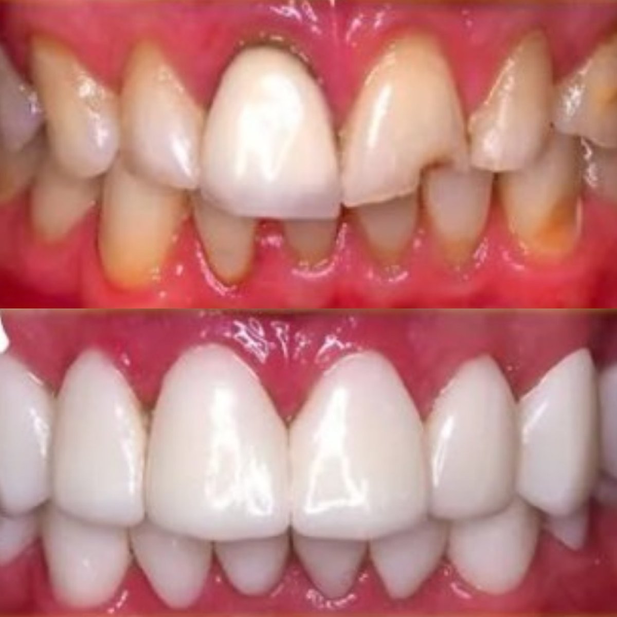 Before and after tooth whitening results at Stellar Dental – visibly brighter, whiter teeth