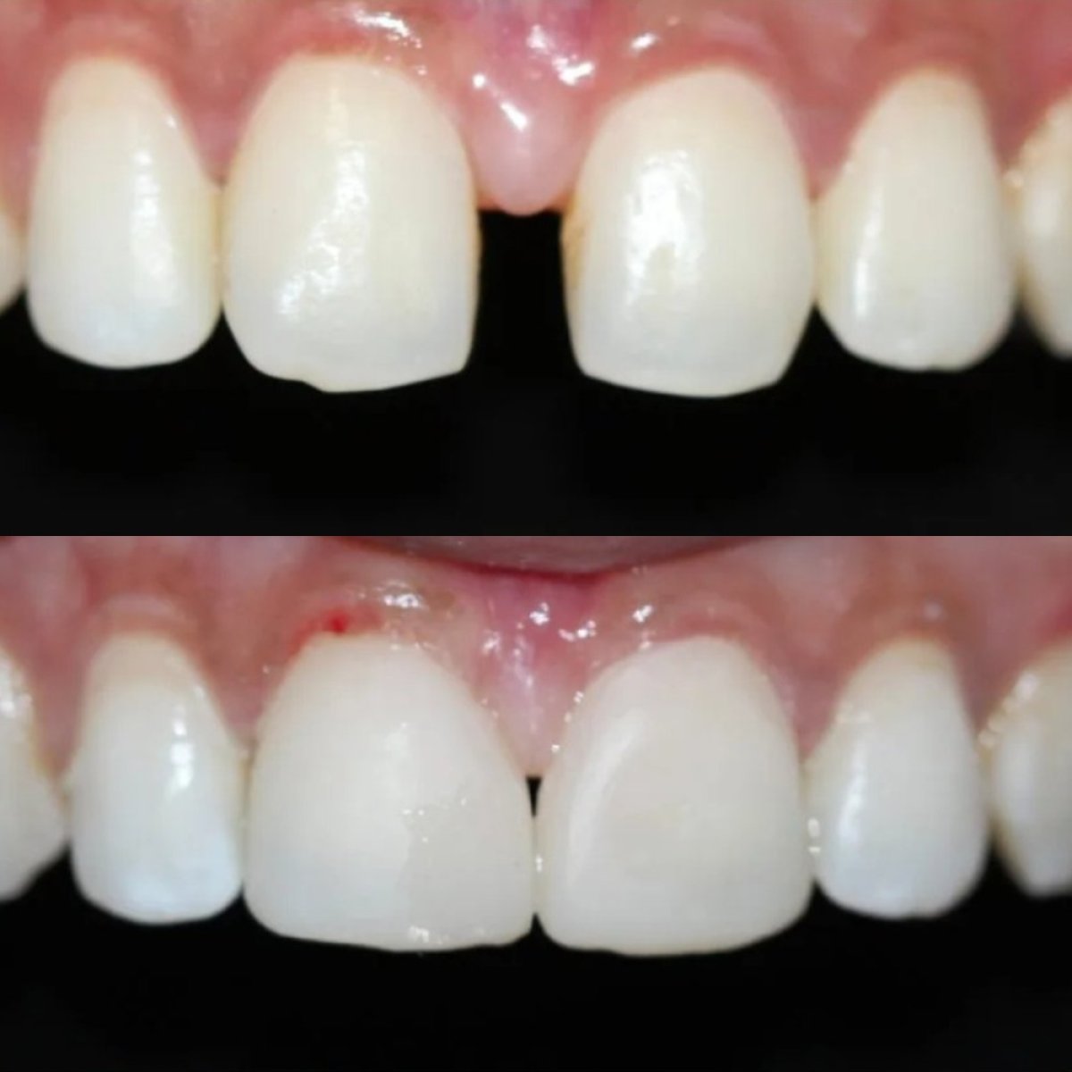 Before and after veneers at Stellar Dental – smile gap closed, natural-looking result