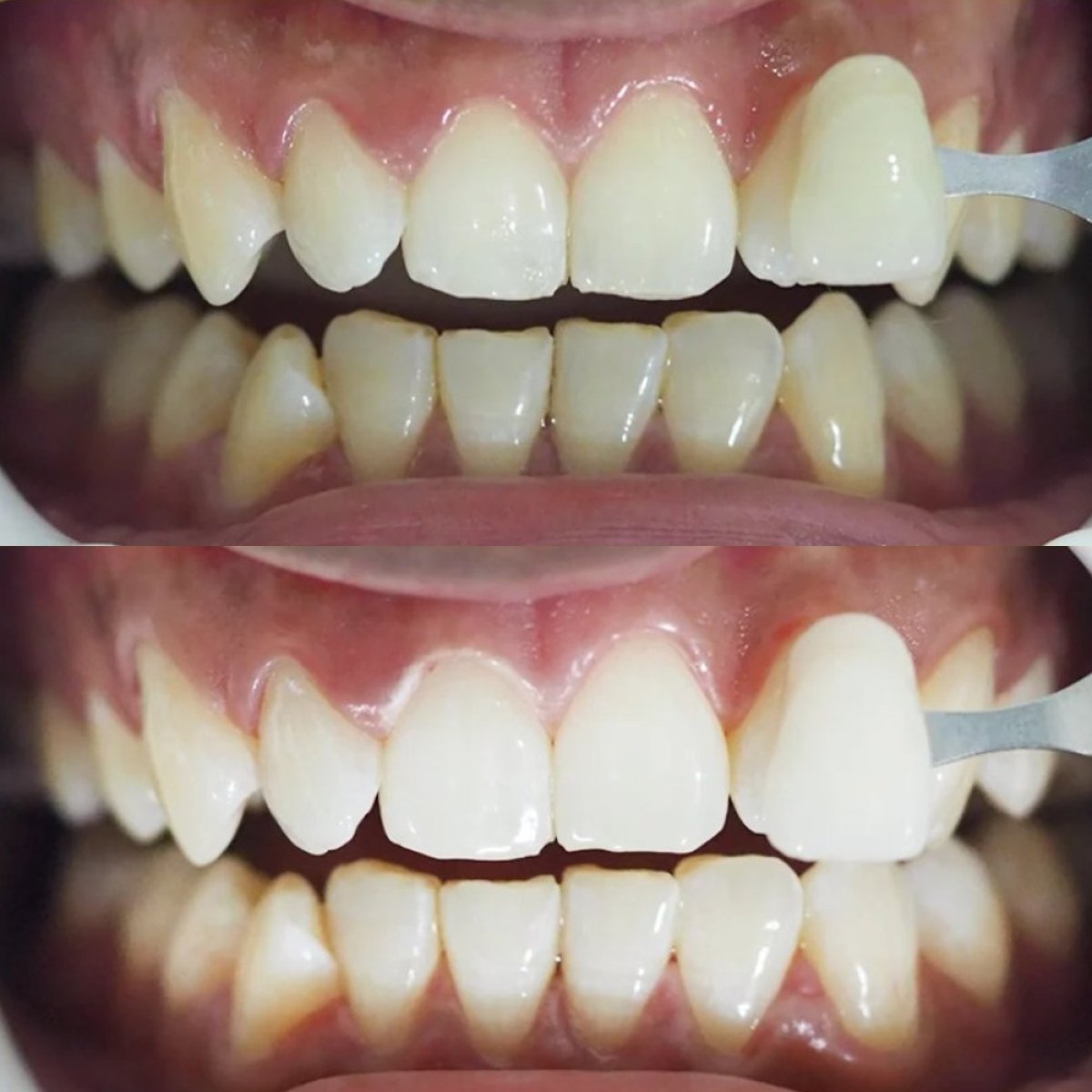 Результаты отбеливания зубов до и после в Stellar Dental – заметно более яркая улыбка