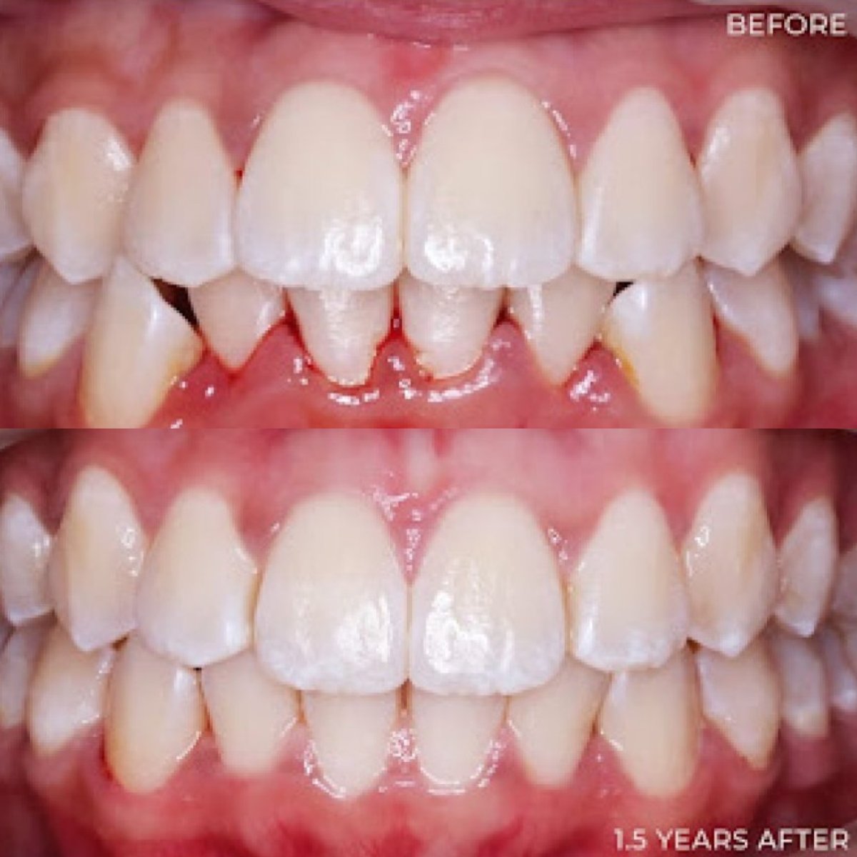 Résultats avant/après Invisalign chez Stellar Dental – alignement dentaire en 1,5 an