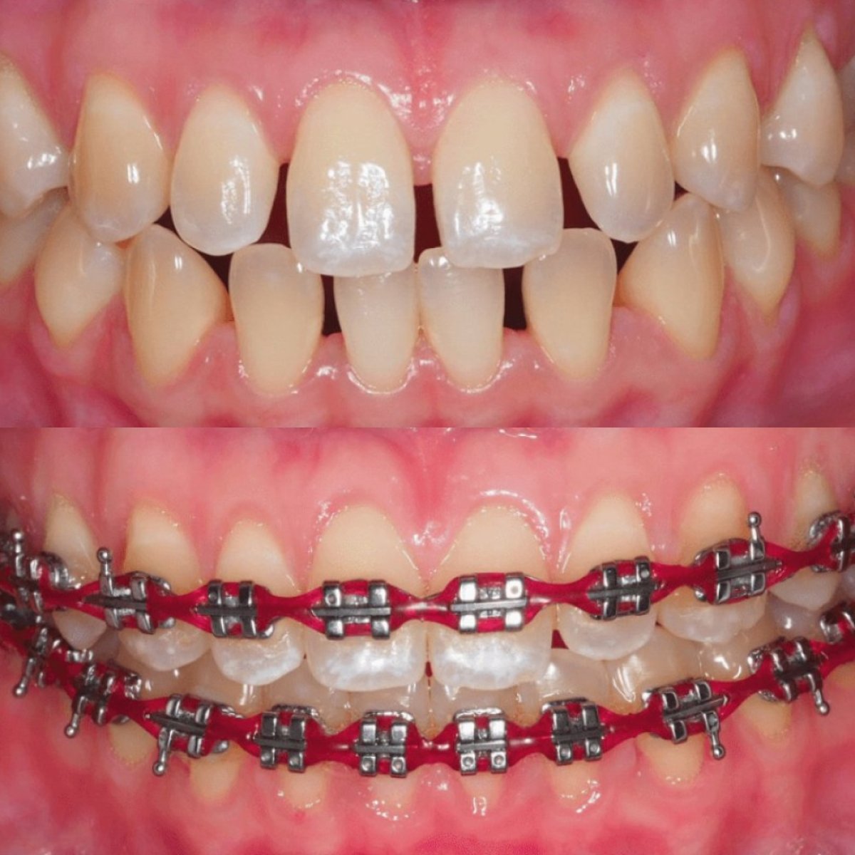 نتائج قبل وبعد تقويم الأسنان المعدني لفك واحد في Stellar Dental، تصحيح الأسنان كوريا