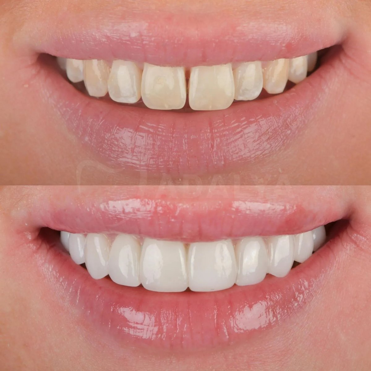 Результаты до и после отбеливания зубов в Adalya Dental Clinic, заметно белее улыбка