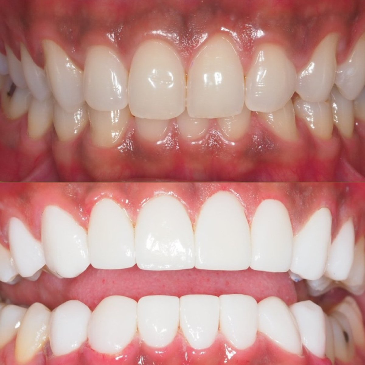 Before and after porcelain veneer results at Stellar Dental – improved smile aesthetics