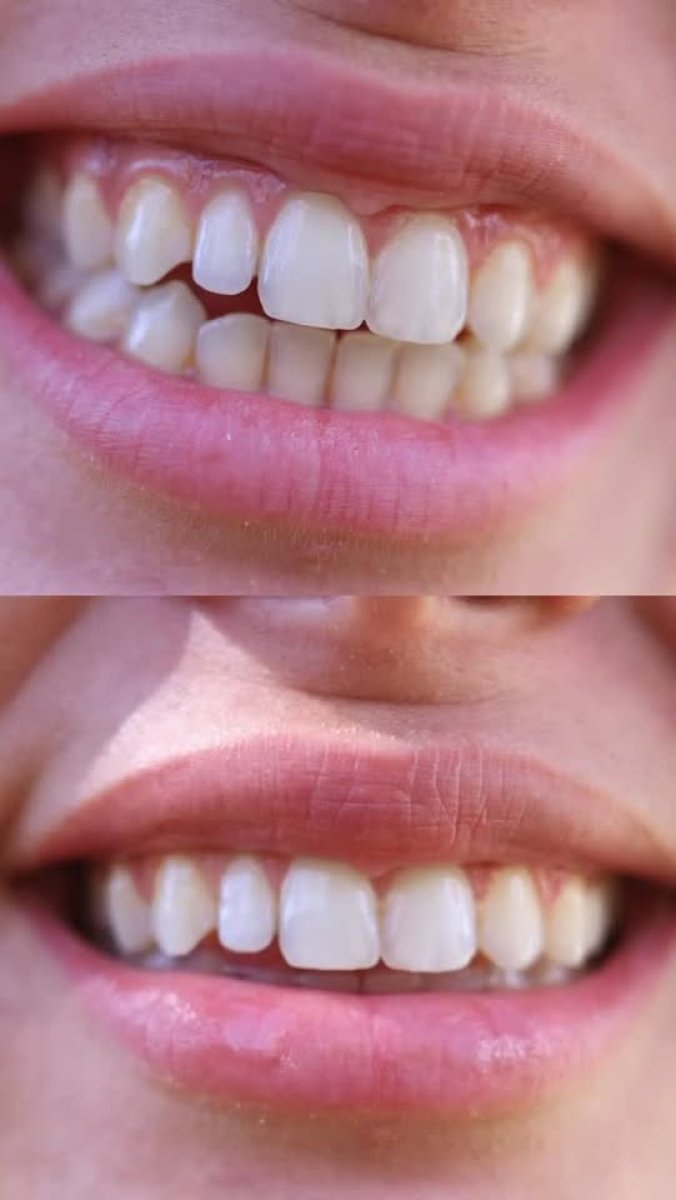 Before and after Invisalign results at AuraDent Aesthetic Clinic, straighter teeth alignment