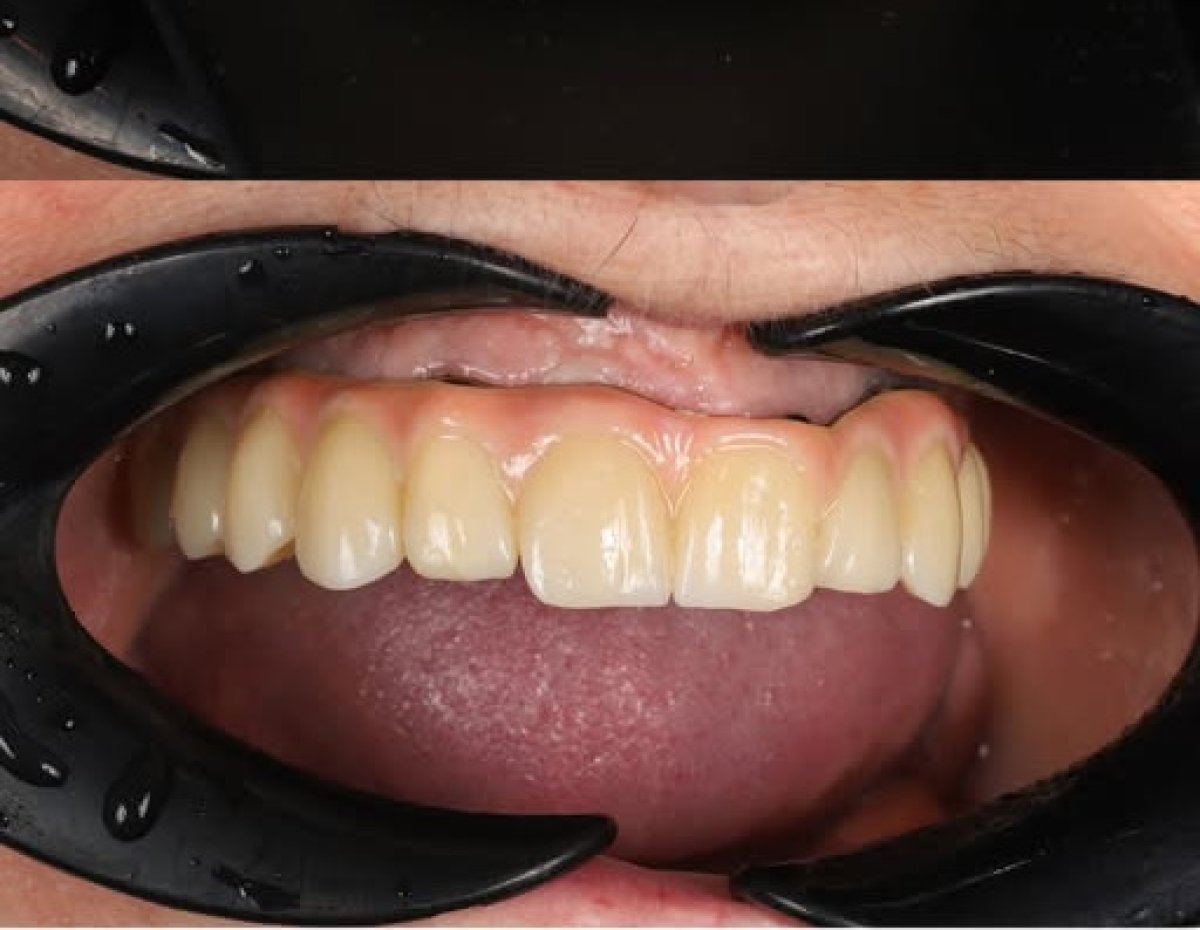 All-on-4 dental implants result at Yourdentist.cz – restored upper teeth and natural smile