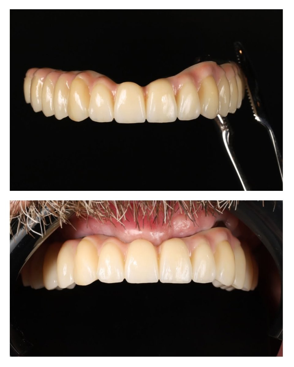 نتيجة زراعة الأسنان All-on-6 في Yourdentist.cz – ترميم كامل للفك بمظهر طبيعي