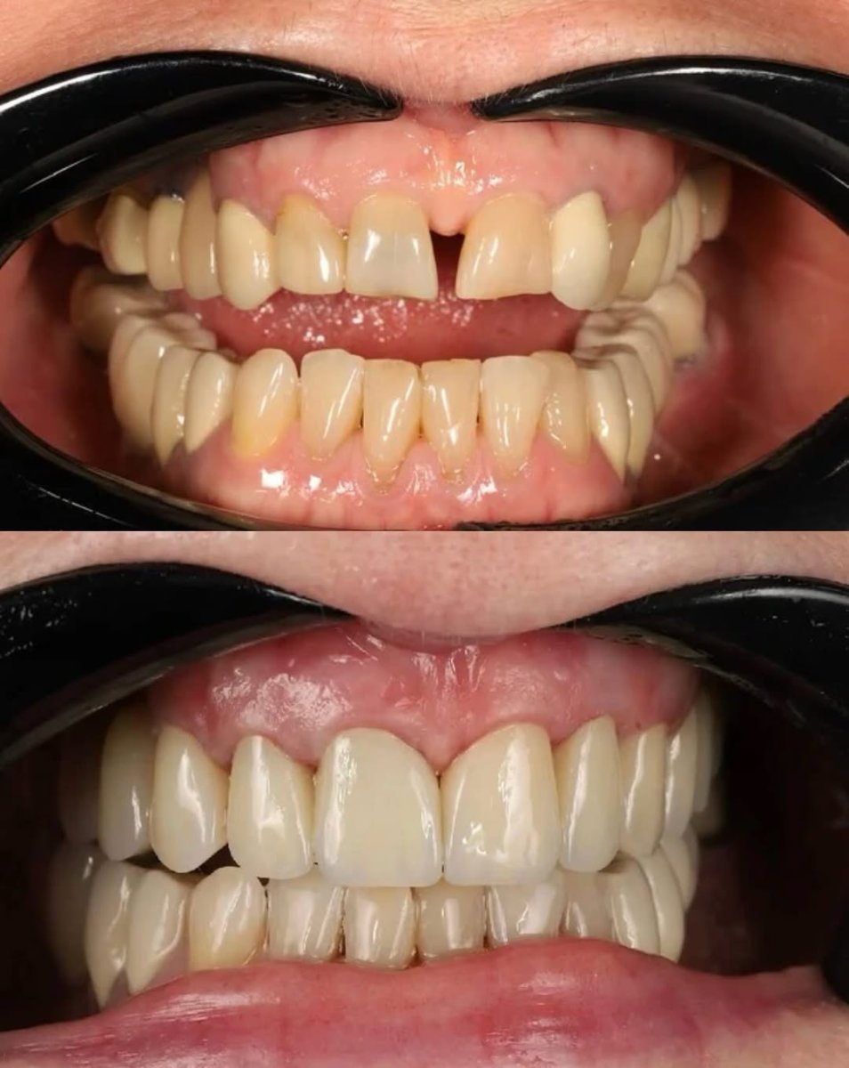 Before and after result of implant-supported dental bridge at Yourdentist.cz, smile restoration