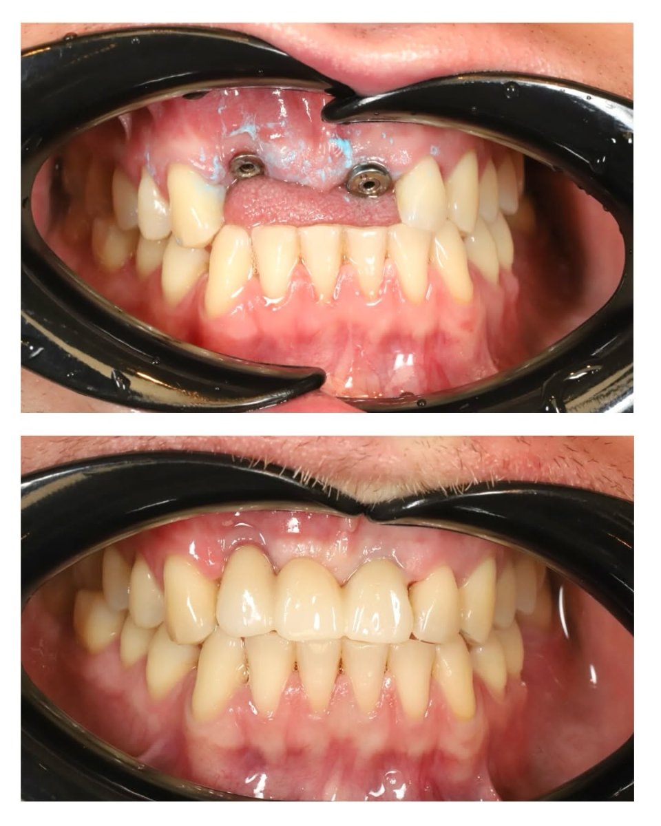 Vorher-nachher-Ergebnis Implantatgetragene Zahnbrücke bei Yourdentist.cz, neues Lächeln