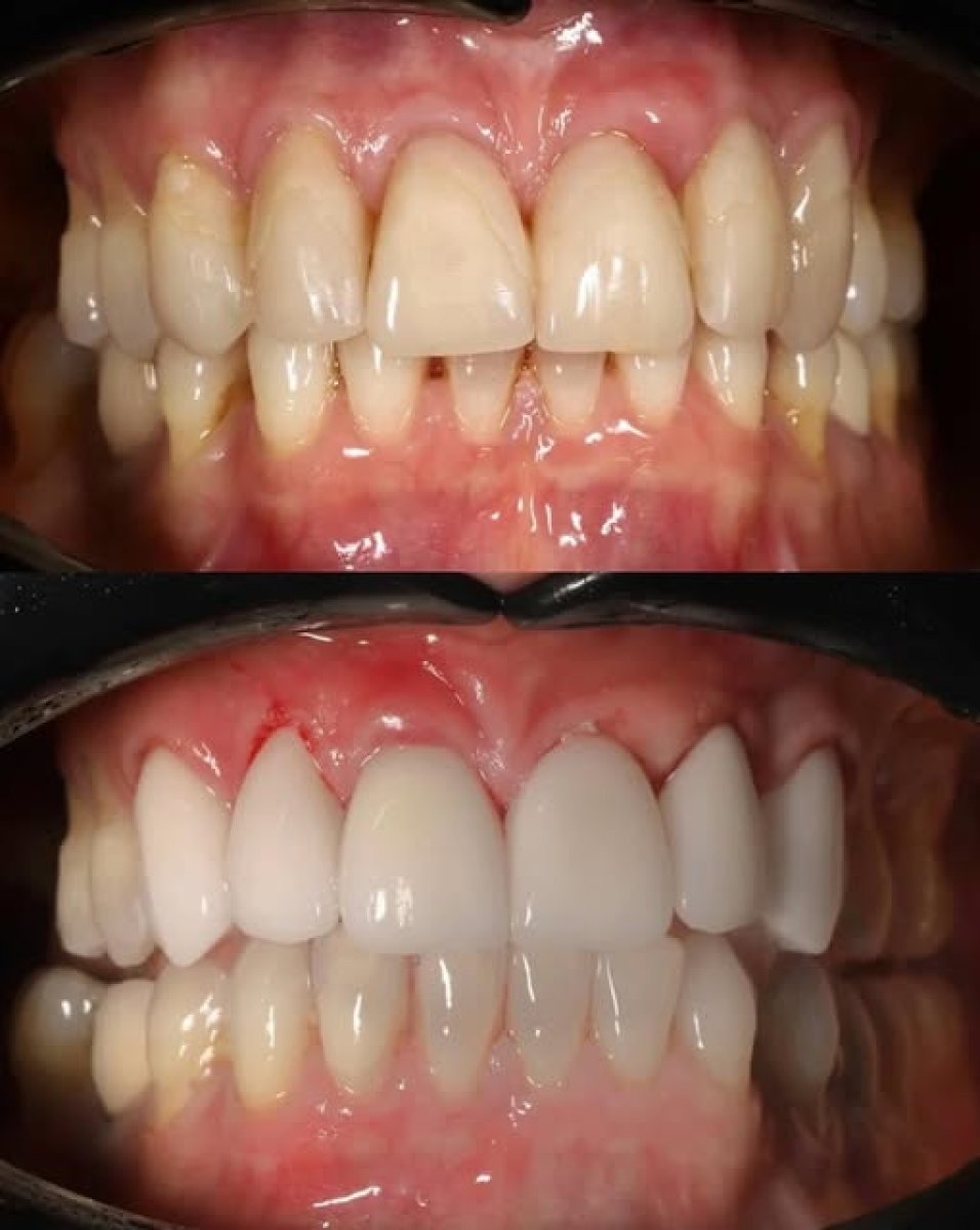 نتائج قبل وبعد عدسات الفينير الخزفية في Yourdentist.cz – ابتسامة أكثر بياضاً