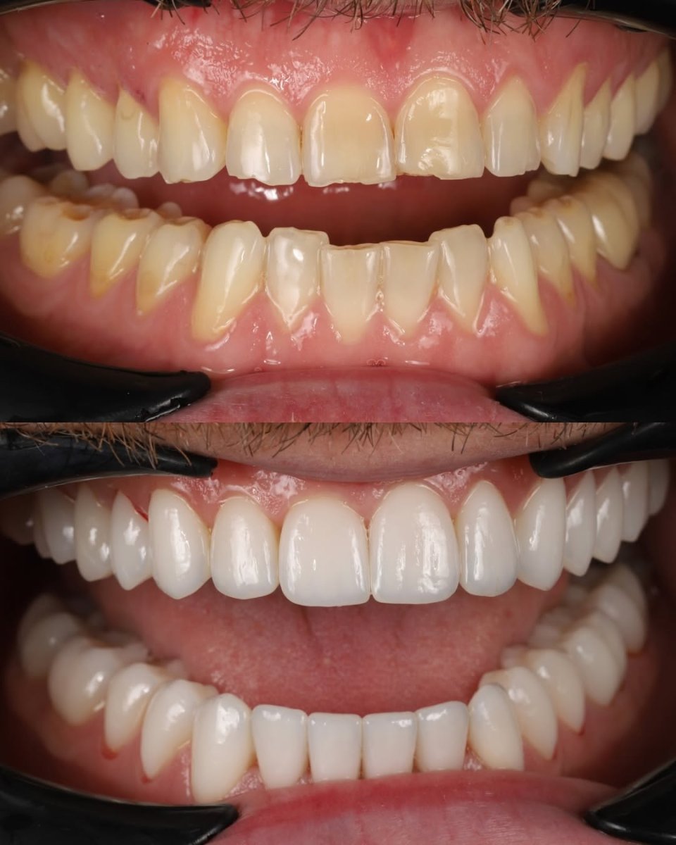 Vorher-nachher-Ergebnis mit Porzellanveneers bei Yourdentist.cz – Lächeln-Verwandlung