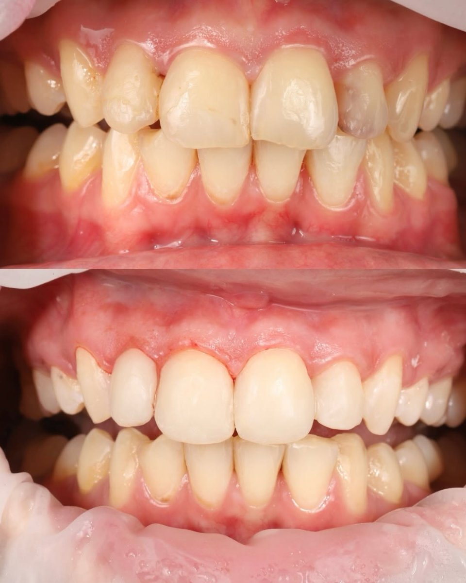 Результаты до и после композитной пломбы в Yourdentist.cz, улучшение передних зубов