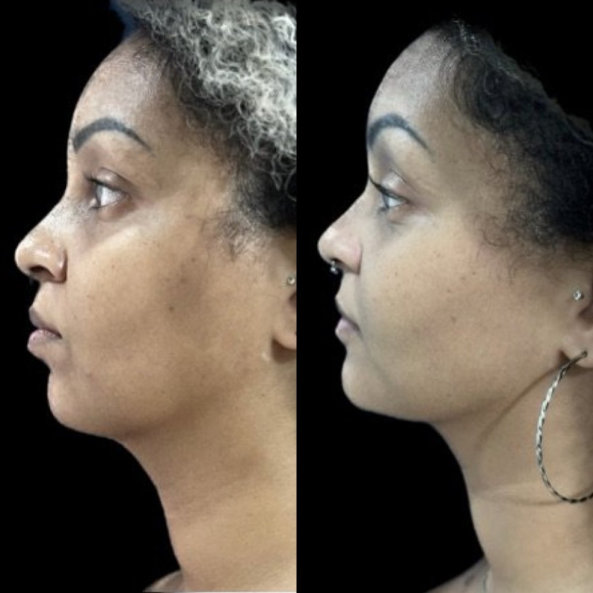 Resultados de liposucción de cuello antes y después en Dr. Michel Salameh - Plastic And Aesthetic Surgery