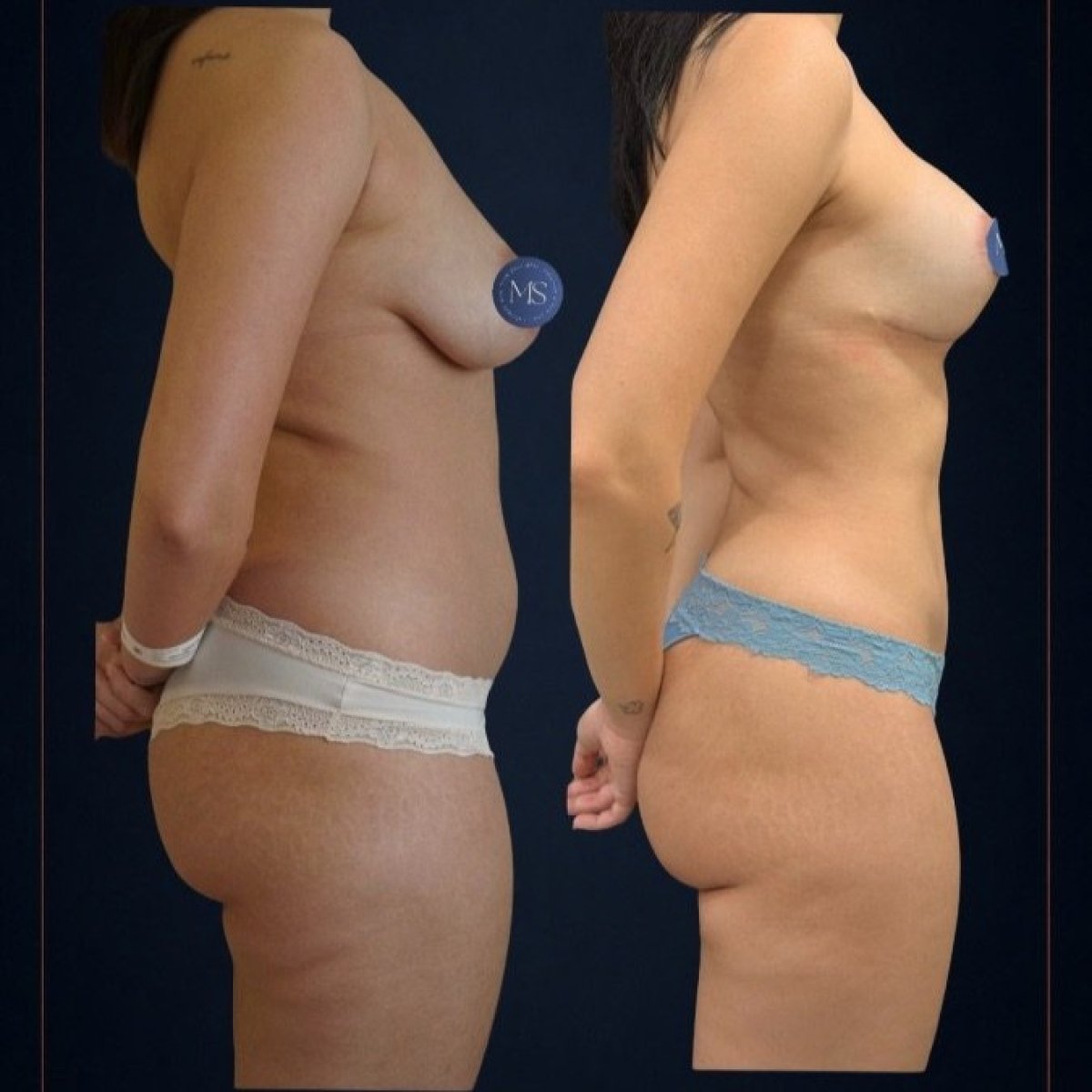 Resultados antes y después de aumento de senos en Dr. Michel Salameh - Plastic And Aesthetic Surgery