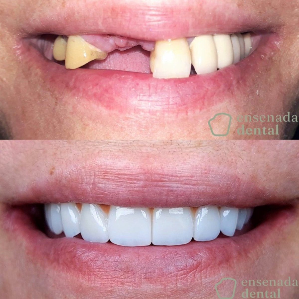 Resultados de All-on-4 en Ensenada Dental: restauración completa de la sonrisa