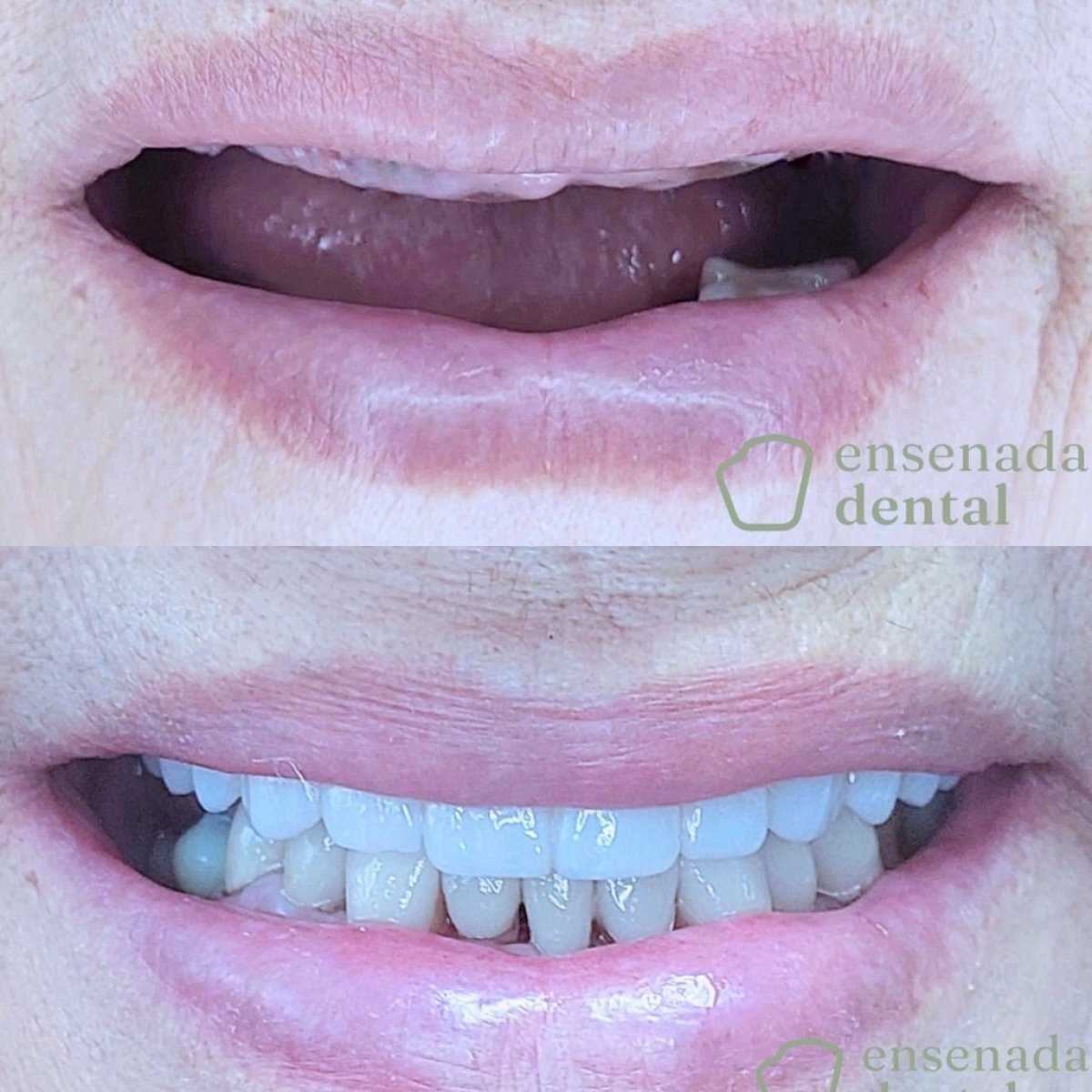 Результат до и после имплантации All-on-4 в Ensenada Dental – восстановленная улыбка