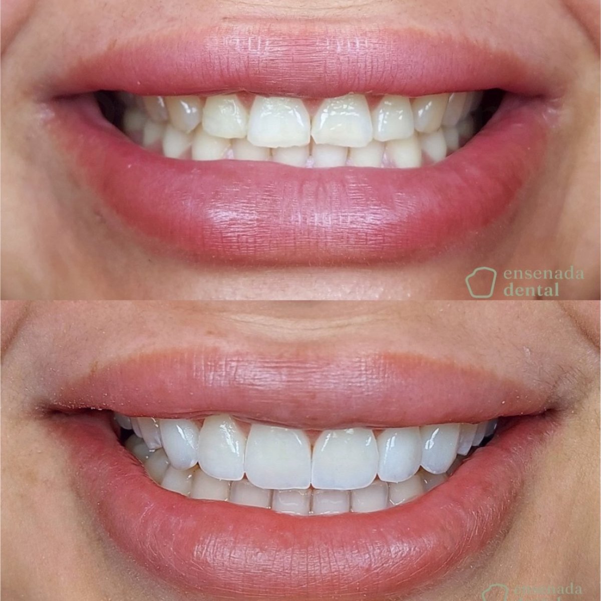 Before and after veneers result at Ensenada Dental – smile transformation with whiter teeth