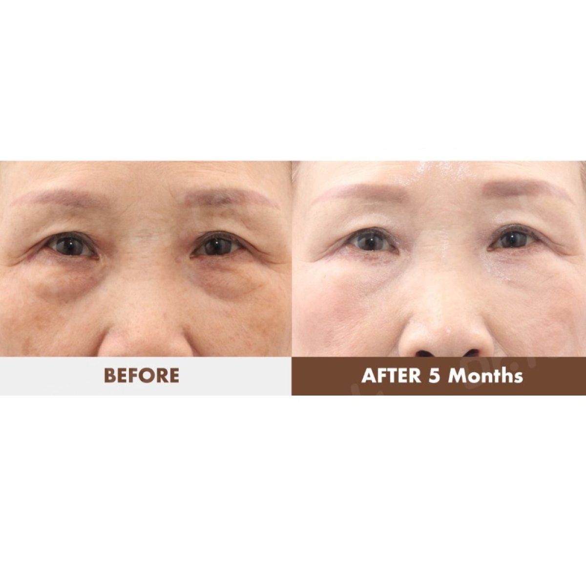 نتائج شد الجفن السفلي قبل وبعد في عيادة Dr. Tak Plastic Surgery بعد 5 أشهر