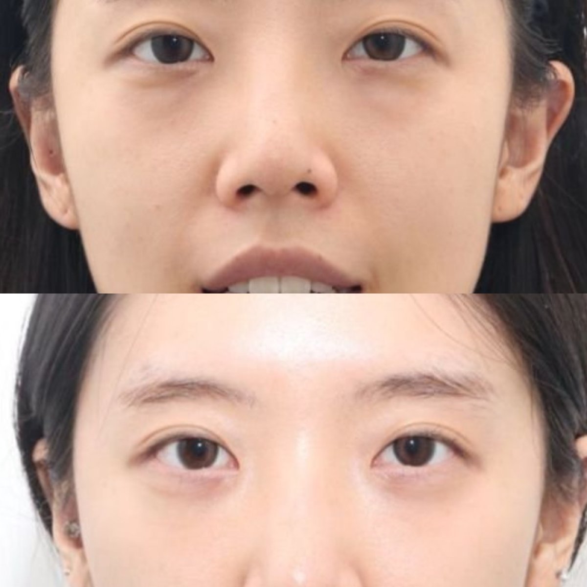 Resultados de blefaroplastia de párpado inferior antes y después en Dr. Tak Plastic Surgery