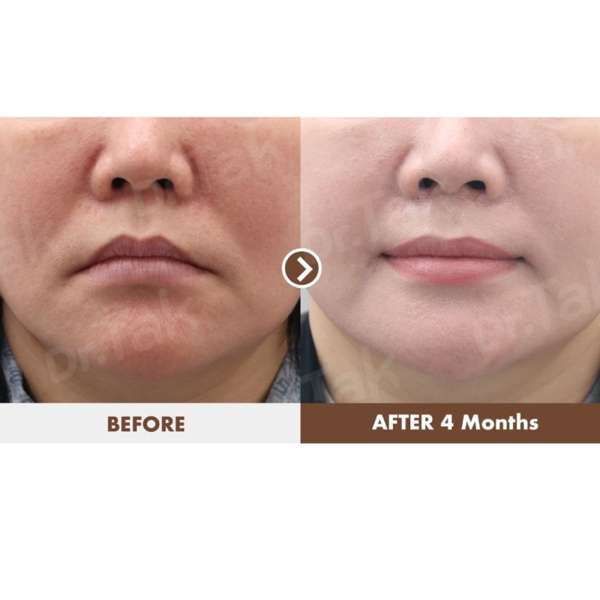 Vorher-nachher-Ergebnis Lippenlifting bei Dr. Tak Plastic Surgery, verbesserte Lippenkontur nach 4 Monaten