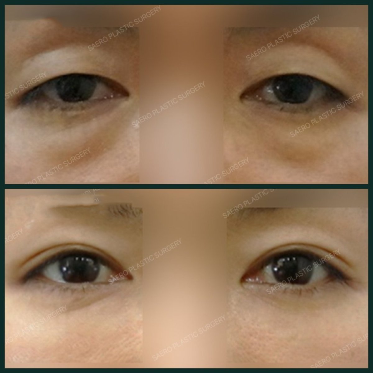 Resultados de blefaroplastia antes y después en SAERO Plastic Surgery, corrección de párpados