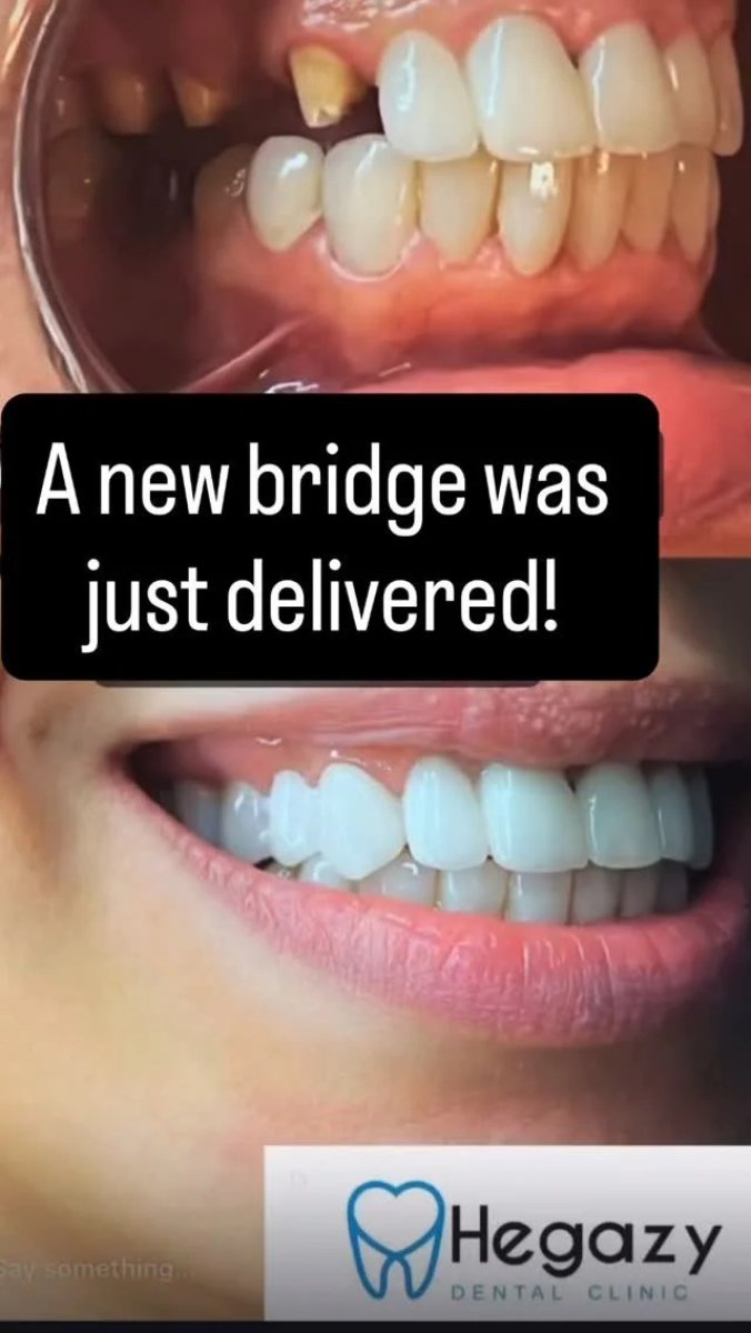 Résultats avant/après pose de bridge dentaire à Hegazy dental clinic, sourire amélioré