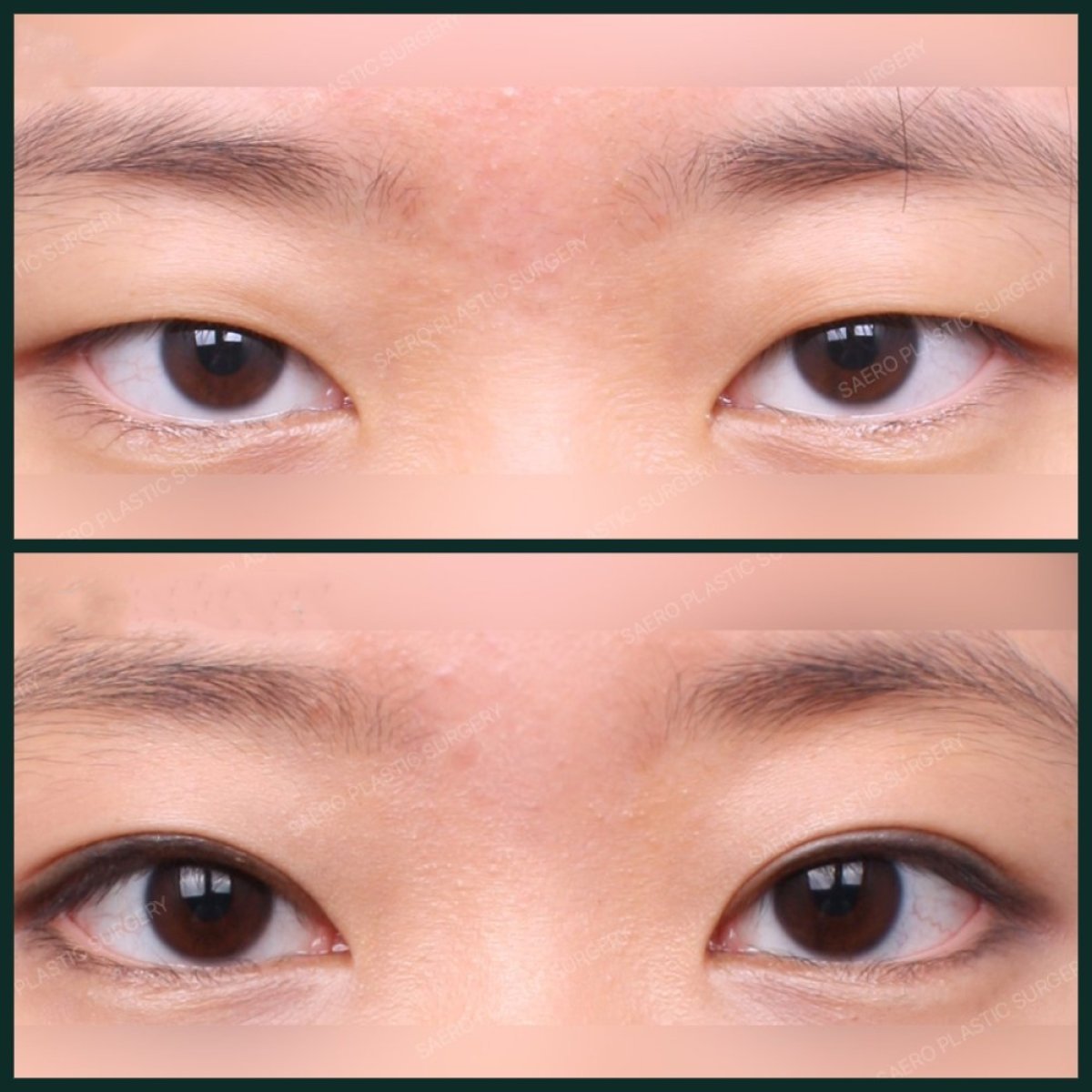 نتائج رأب الجفن قبل وبعد في SAERO Plastic Surgery، تصحيح الجفون