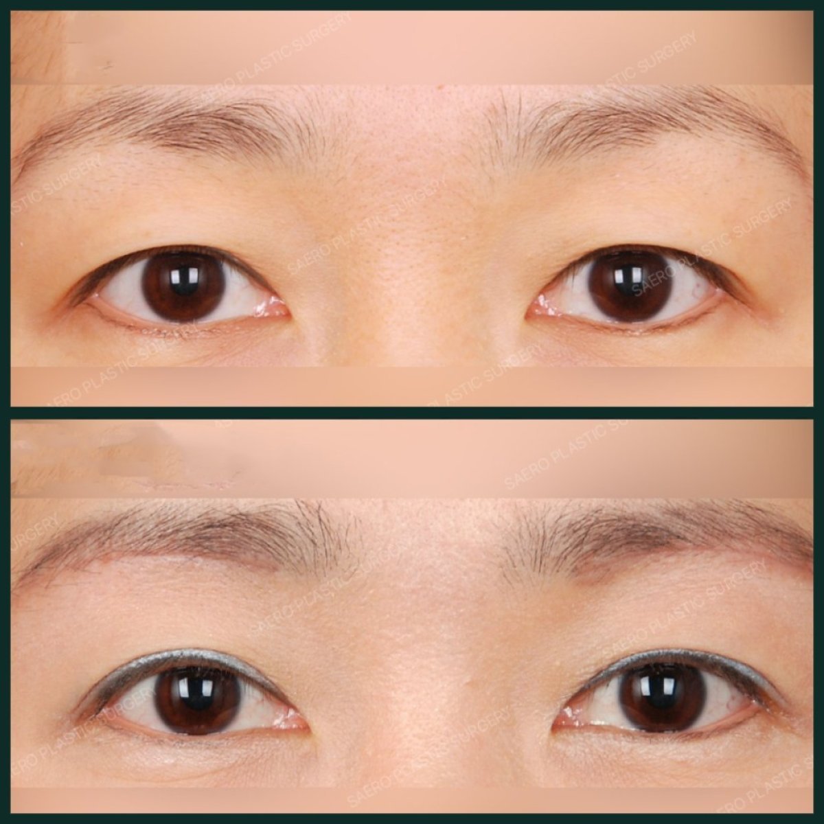 Résultats avant/après blépharoplastie chez SAERO Plastic Surgery, correction des paupières