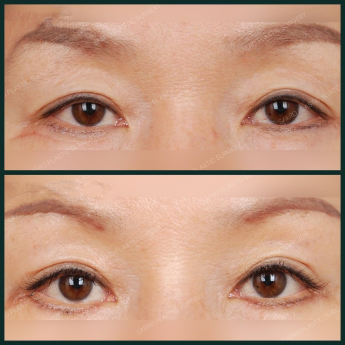 نتائج رأب الجفن قبل وبعد في SAERO Plastic Surgery، تصحيح الجفون