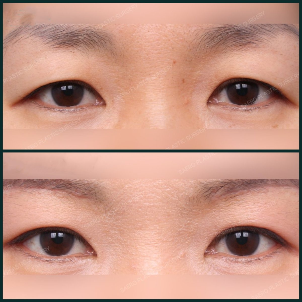 Resultados de blefaroplastia antes y después en SAERO Plastic Surgery, corrección de párpados