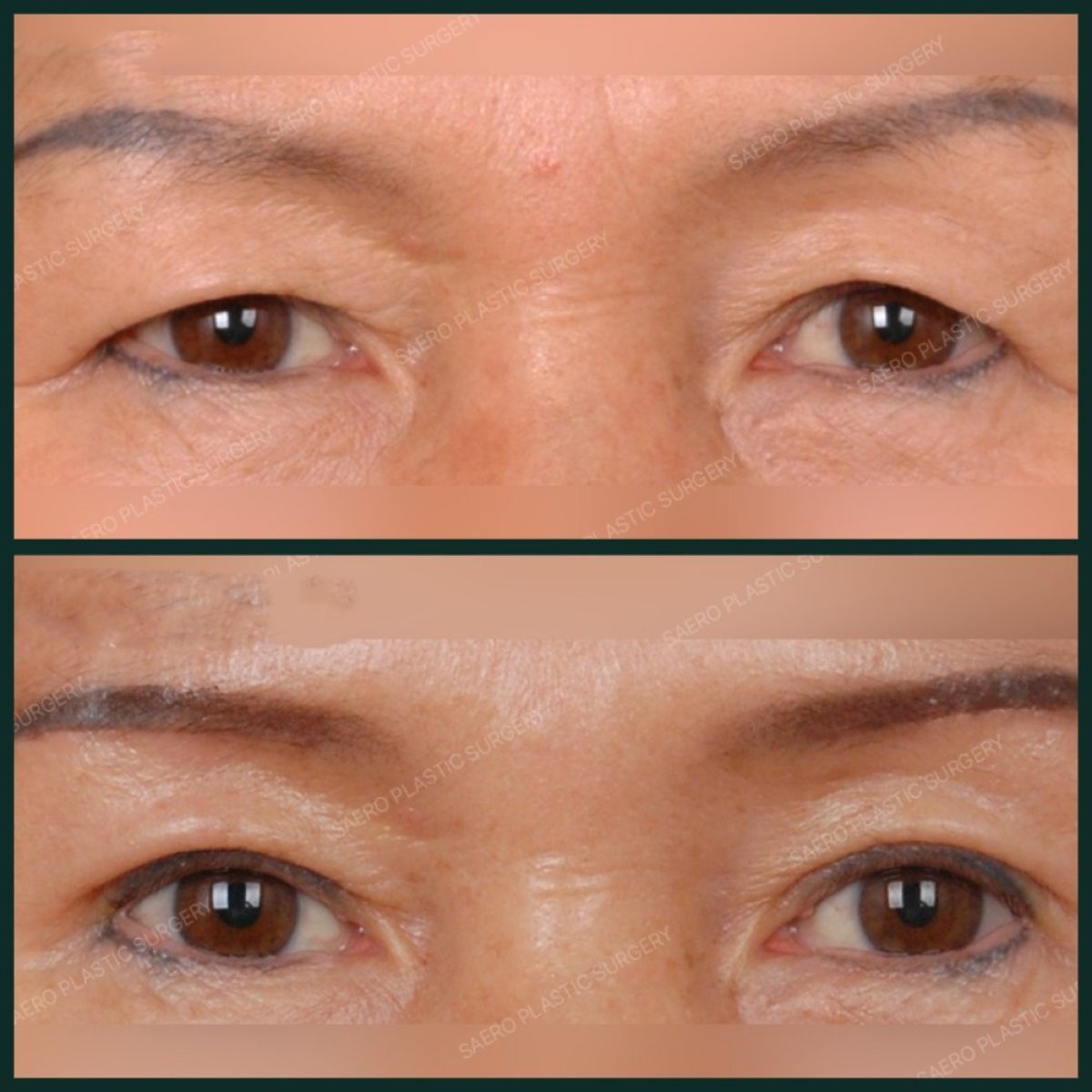Результати блефаропластики до і після в SAERO Plastic Surgery, корекція повік