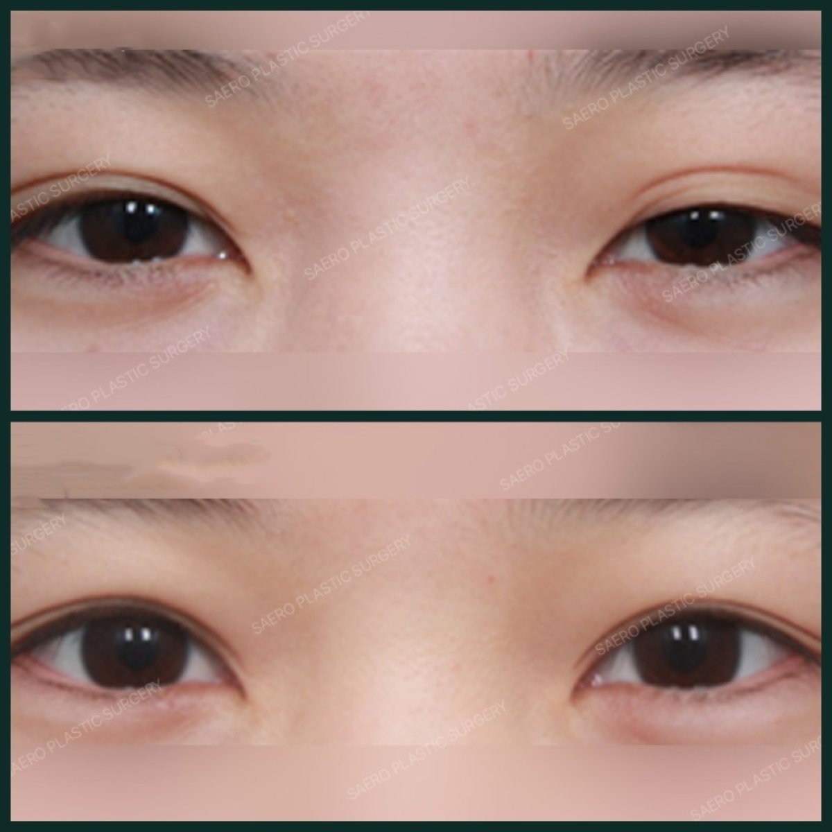 Resultados de blefaroplastia antes y después en SAERO Plastic Surgery, corrección de párpados