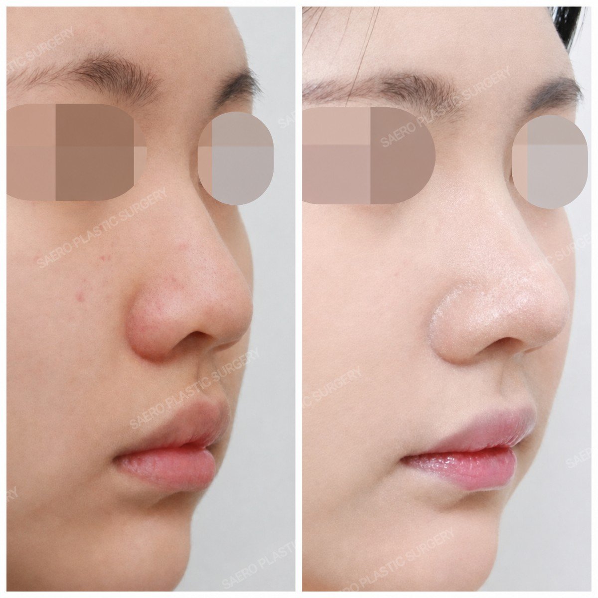 نتائج عملية تجميل الأنف قبل وبعد في SAERO Plastic Surgery، تحسين شكل الأنف