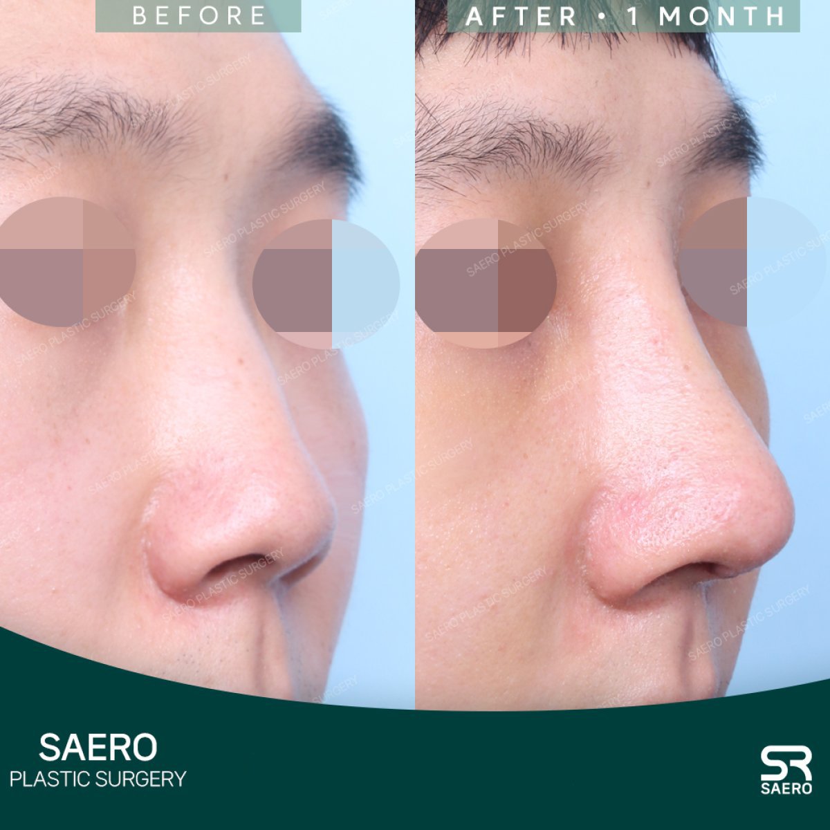 نتائج تجميل الأنف قبل وبعد في SAERO Plastic Surgery، إعادة تشكيل الأنف بعد شهر