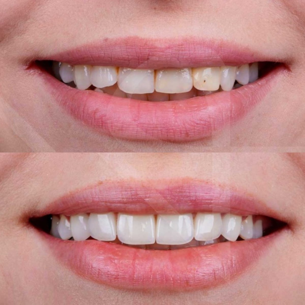 Resultados antes y después de Hollywood Smile en Vialife Clinic: dientes más blancos y parejos