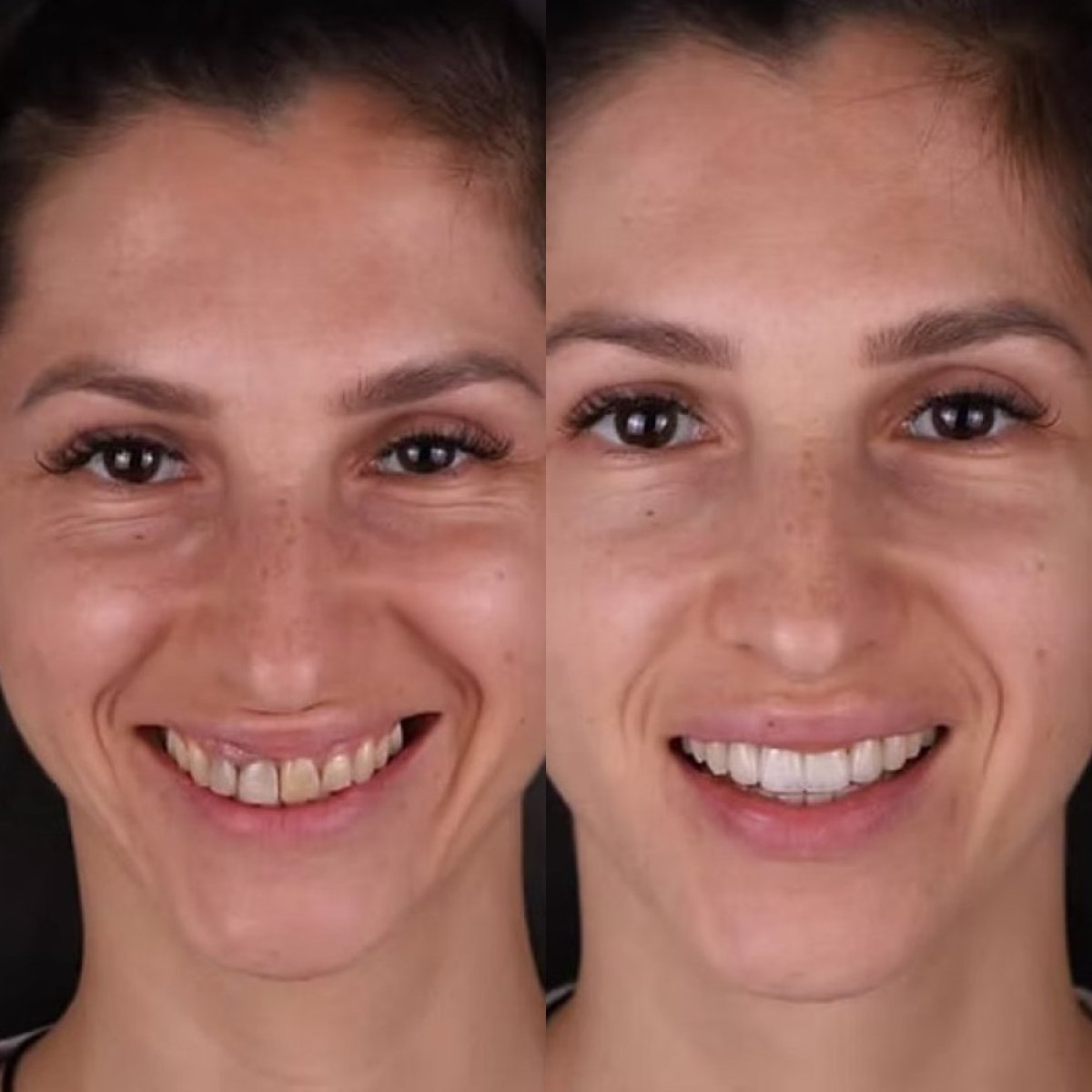 Результати до і після відбілювання зубів у Go To Smile – помітно біліша посмішка