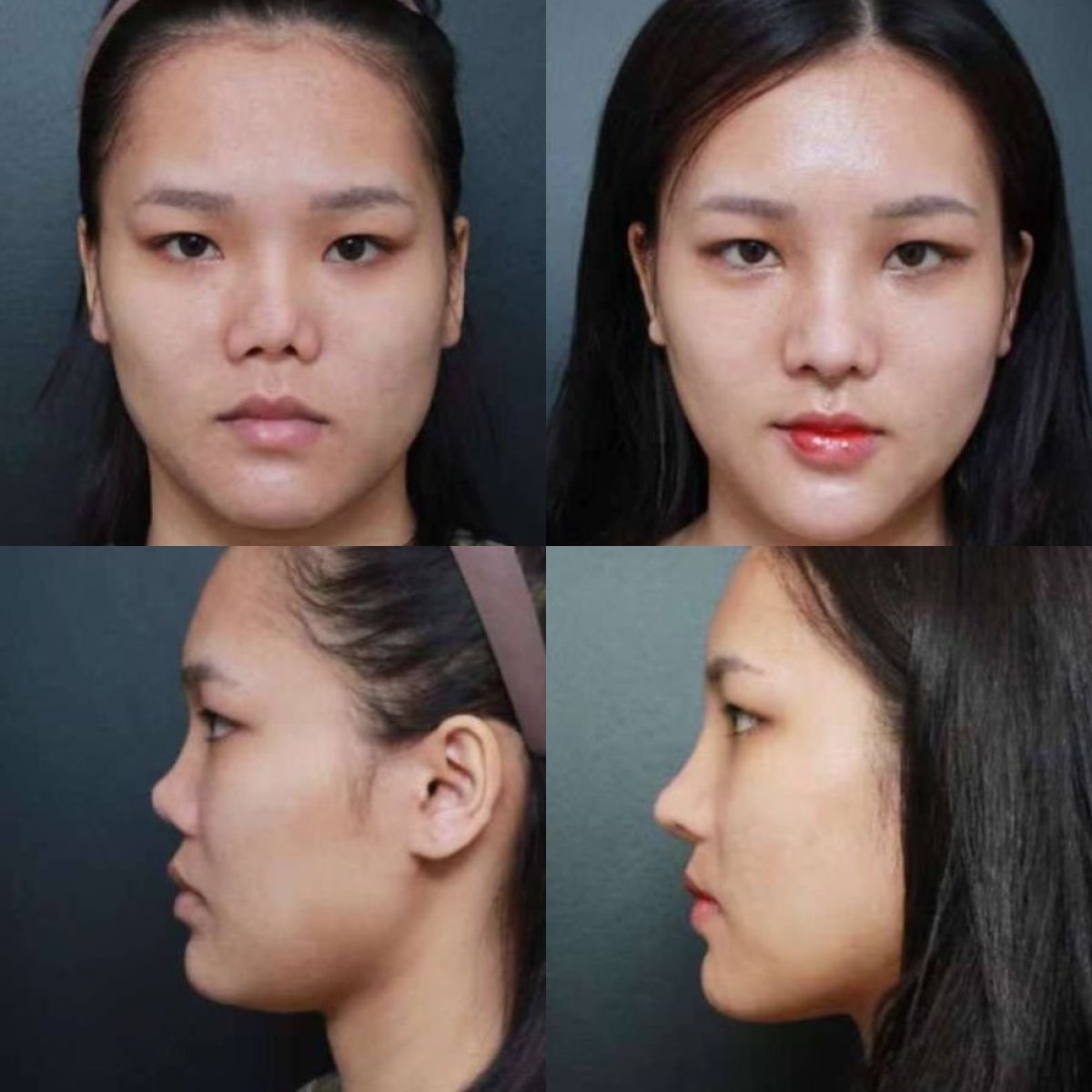 Before and after tip rhinoplasty results at VG Plastic Surgery, nose reshaping improvement