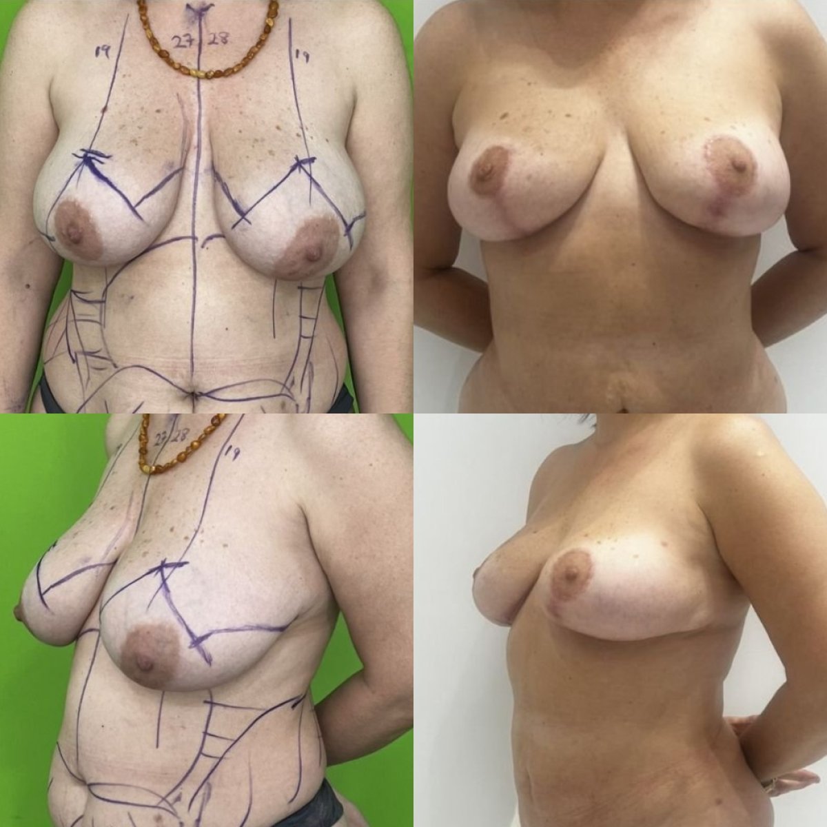نتائج تصغير الثدي قبل وبعد في عيادة Prof. Dr. Furkan Karabekmez للجراحة التجميلية أنقرة