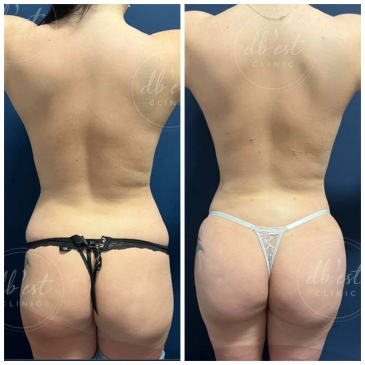 نتائج قبل وبعد عملية Brazilian Butt Lift في Db'est Clinic – تحسين شكل الأرداف