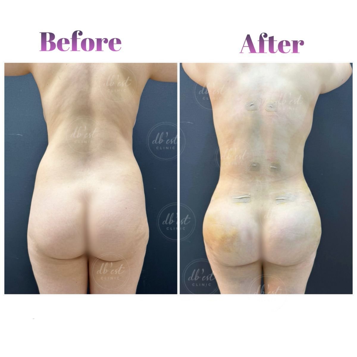 نتائج قبل وبعد عملية Brazilian Butt Lift في Db'est Clinic – تحسين شكل الأرداف