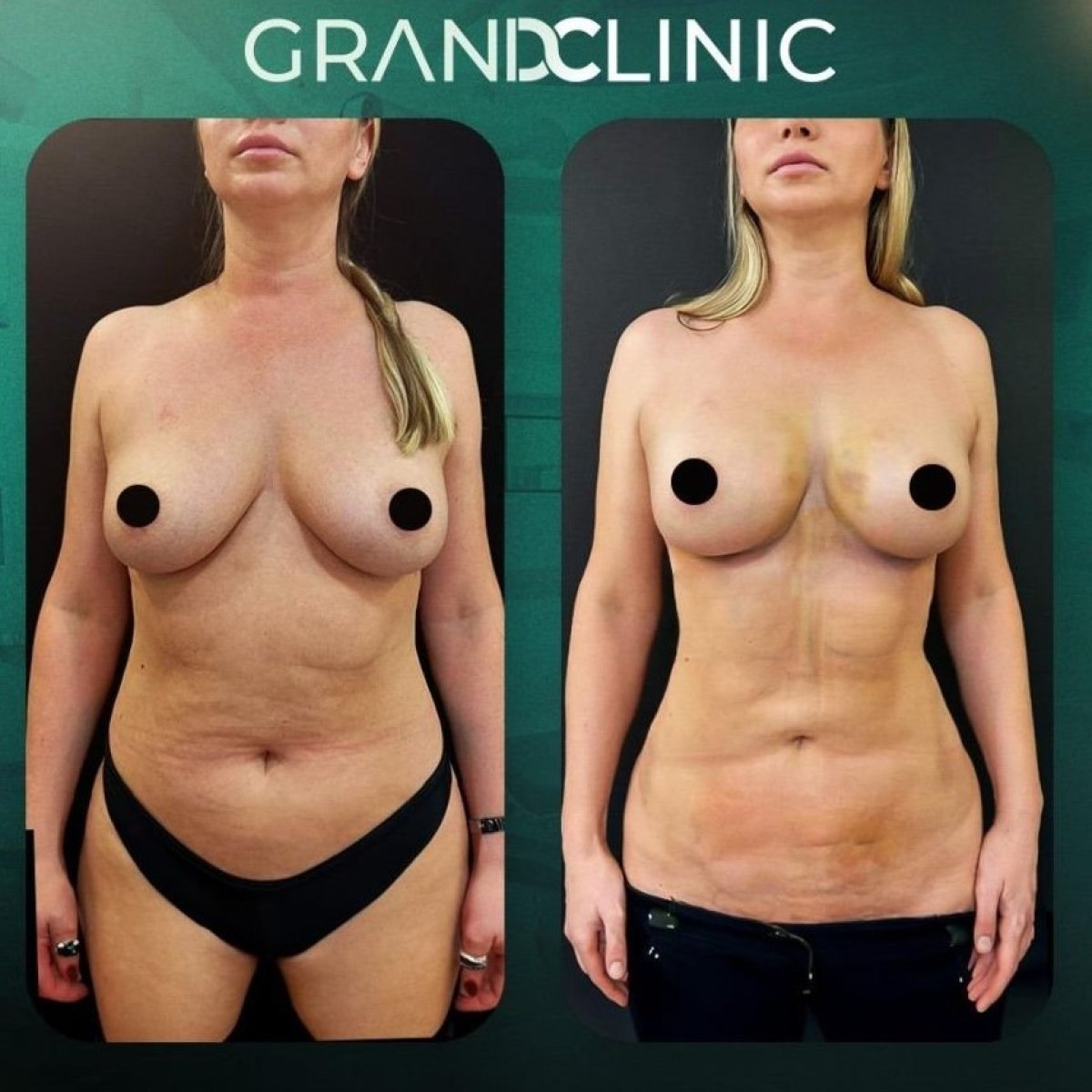 نتائج قبل وبعد عملية تكبير الثدي في Grand Clinic – تغييرات واضحة في الصدر والجسم