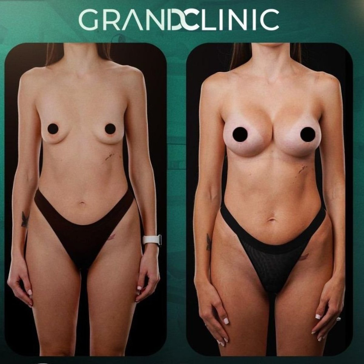 Результаты маммопластики до и после в Grand Clinic – улучшенная форма и объем груди