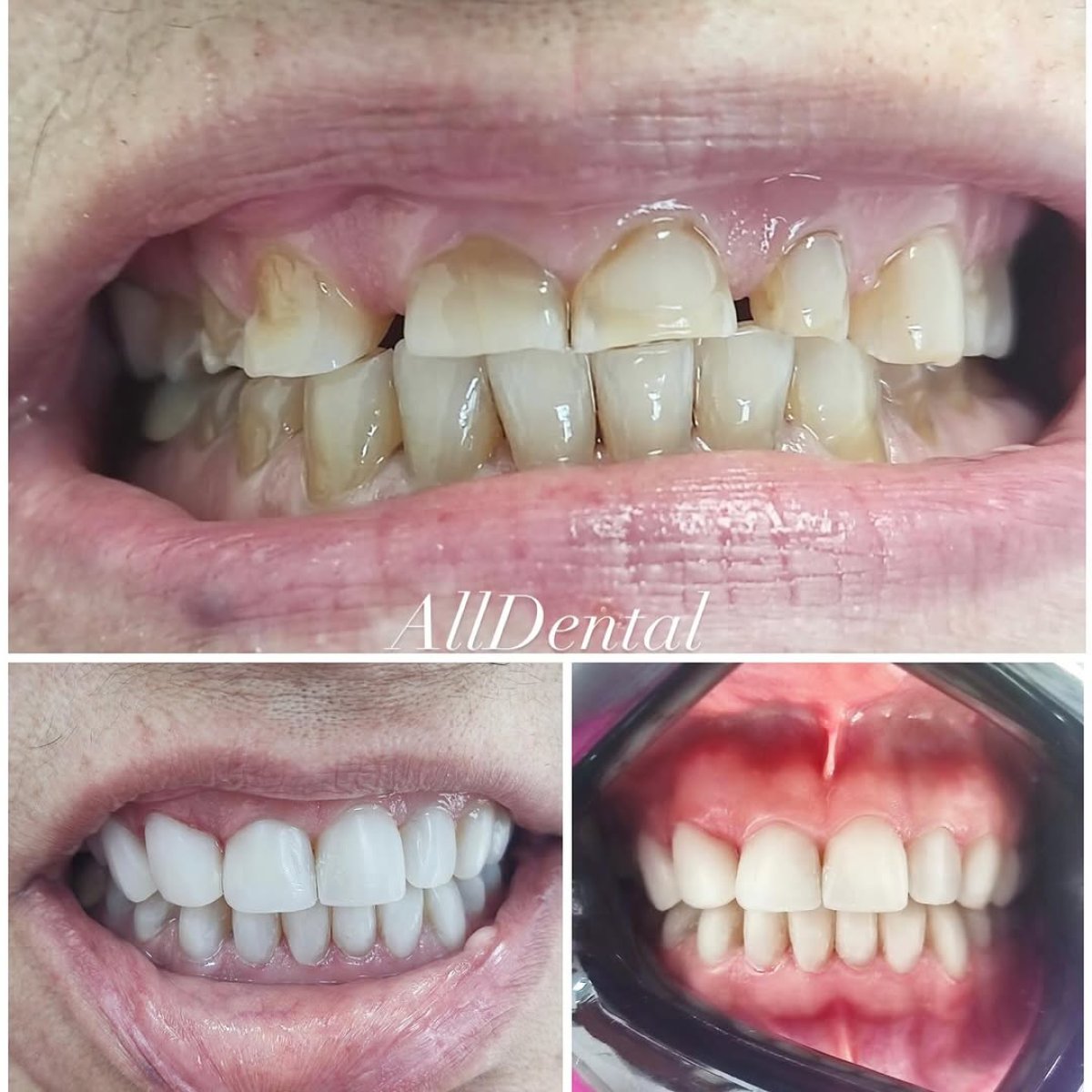 Before and after dental crown installation results at AllDental Clinic, improved smile aesthetics