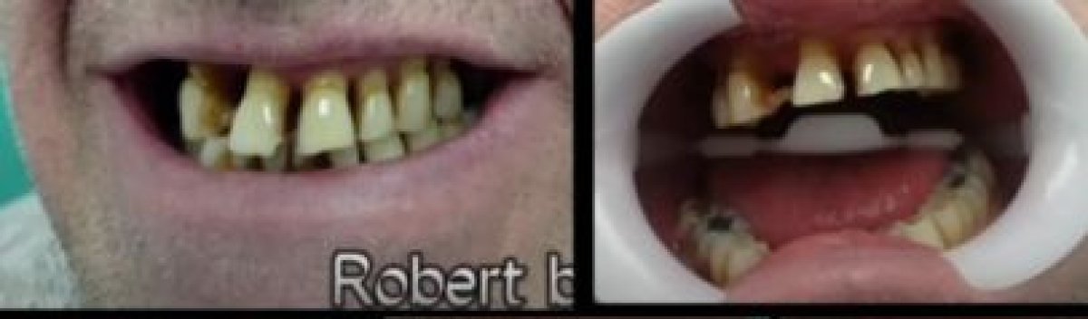 Before and after Invisalign treatment results at AllDental Clinic for teeth alignment improvement