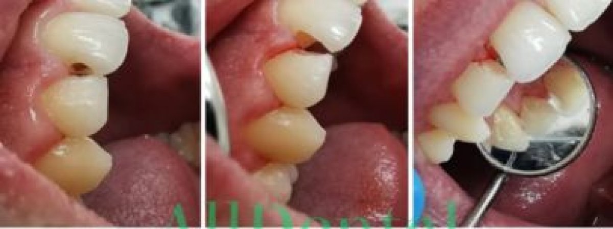 Результаты до и после установки импланта с коронкой в AllDental Clinic, восстановление зуба