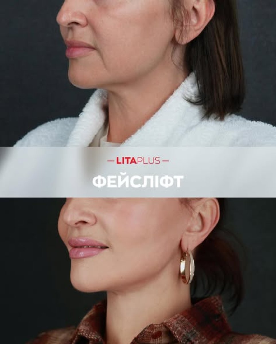 Resultados de lifting facial antes y después en Lita Plus, rejuvenecimiento visible